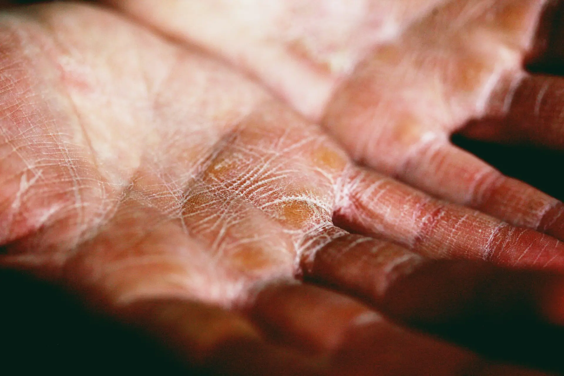 Poor gut bacteria and food sensitivities are the primary culprits behind eczema. Dairy and gluten are the most common triggers, so testing for these and/or removing them from your diet is a great place to start. Eat to Achieve is a gluten-free, dairy-free food plan designed to help manage eczema.