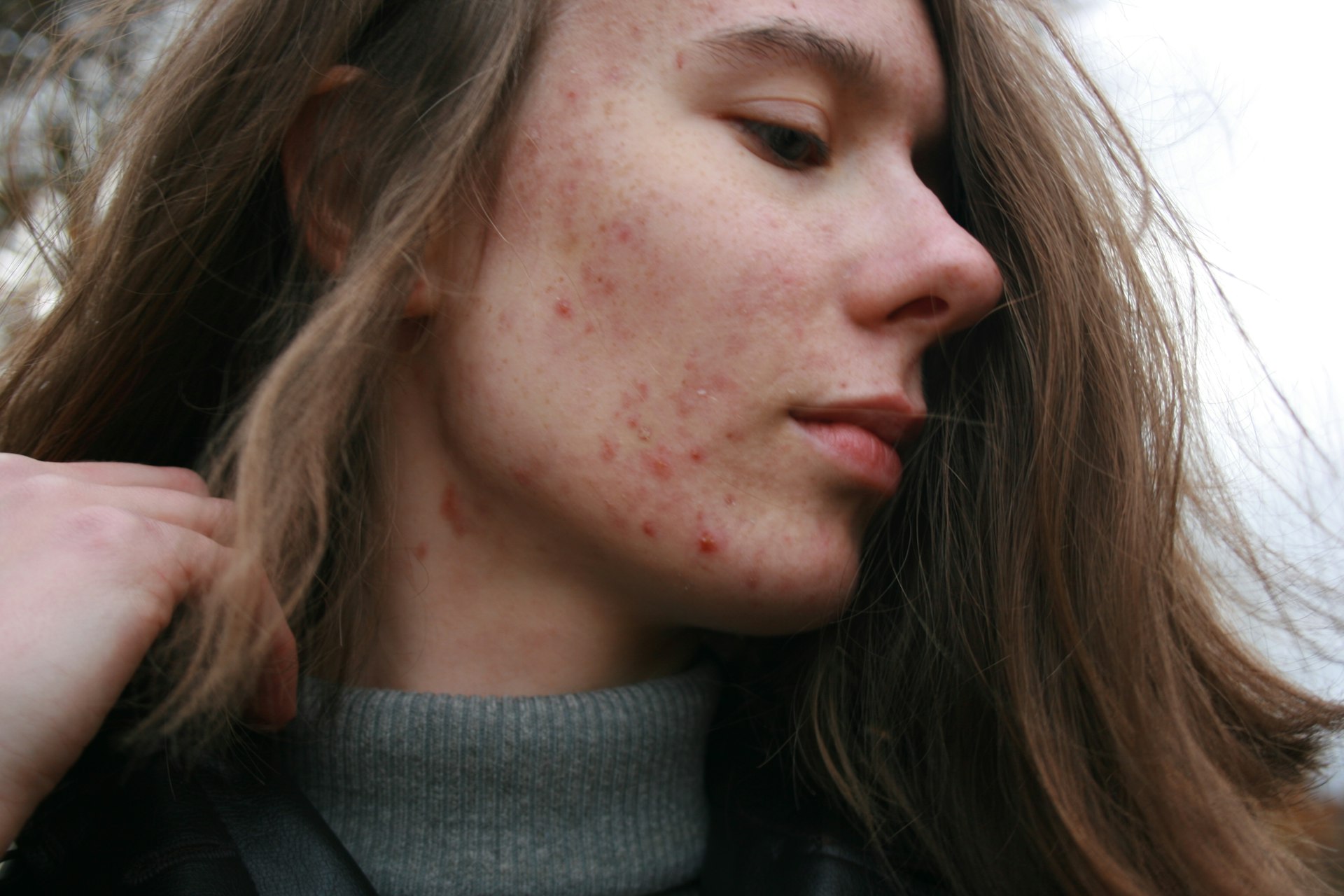 Acne affects a large part of the population, and its causes can be as complex as the condition itself. Research shows that around 37% of people with acne also experience gut-related symptoms, while 40% may struggle with low stomach acid. One of the most common triggers? Dietary sensitivities—especially to dairy.